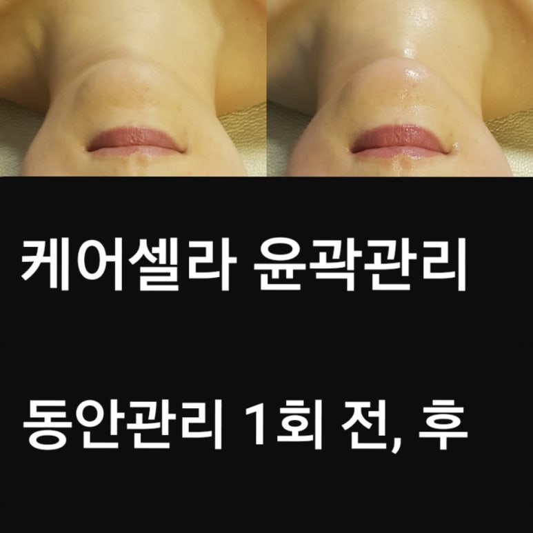 케어셀라 이미지