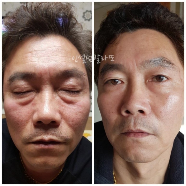 피부미인인셀덤 이미지