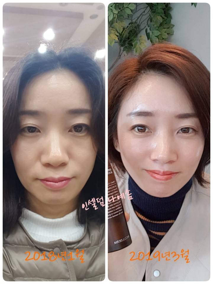 피부미인인셀덤 이미지