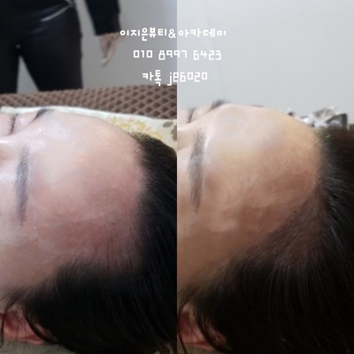 미헤어라인 이미지