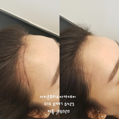 미헤어라인 이미지