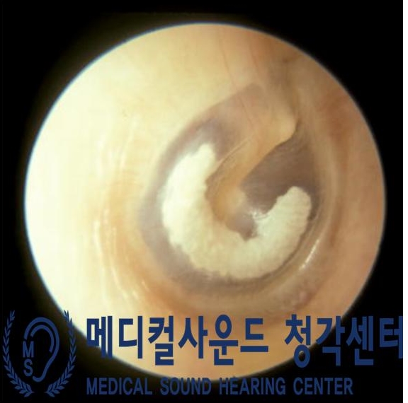 경화반점 이미지