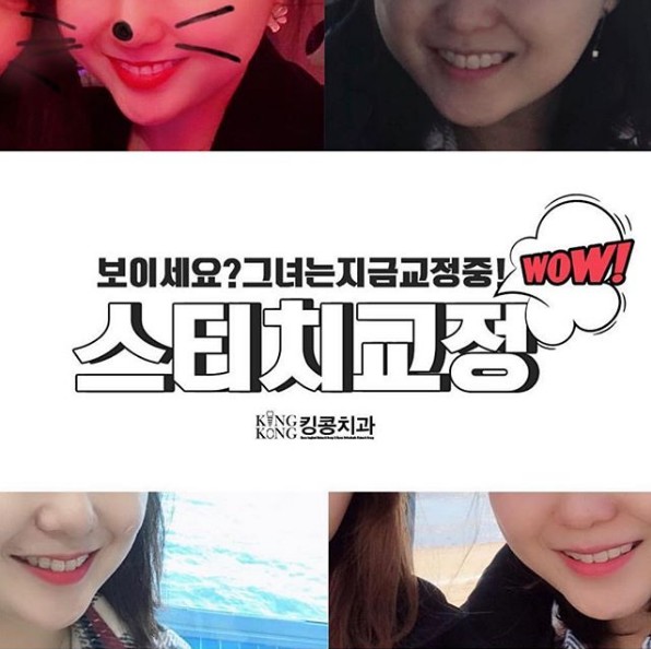 스티치킹콩 이미지