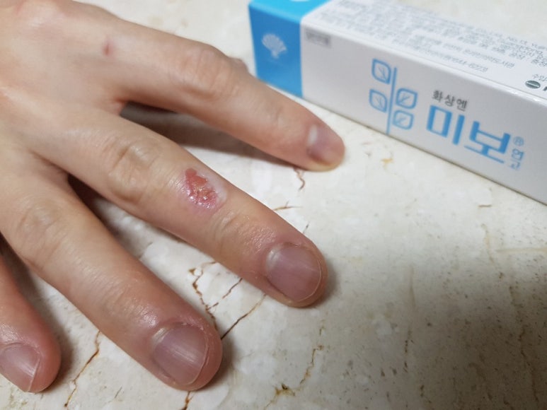 화상연고 미보연고 바르고 나아가는 중 : 네이버 블로그 화상연고 미보연고 바르고 나아가는 중 : 네이버 블로그