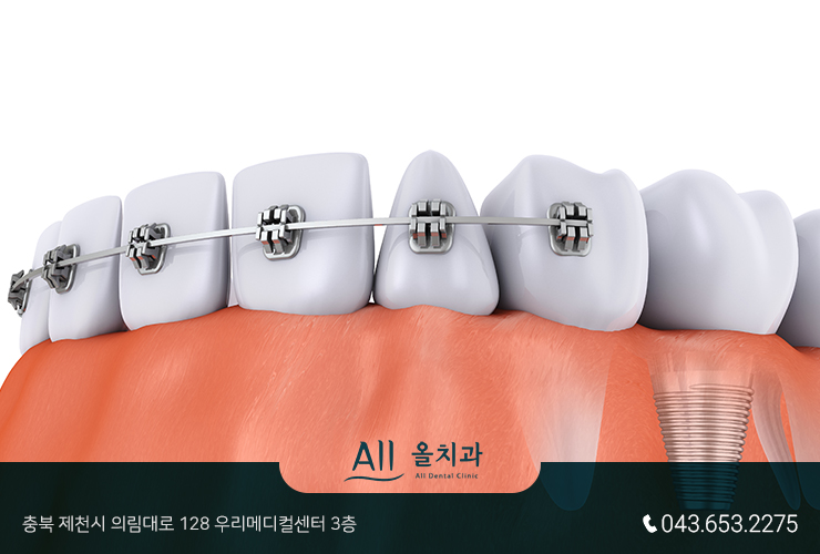 스크류비어 이미지