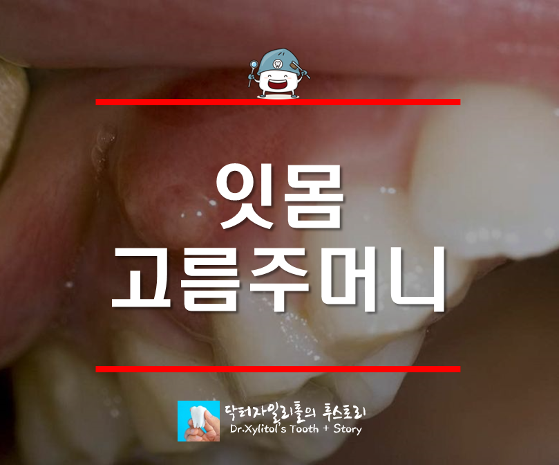 잇몸 염증 고름주머니 ( 잇몸에 생긴 혹 ) 이유와 치료 :: 치근단 염증 By 닥터자일리톨 : 네이버 블로그