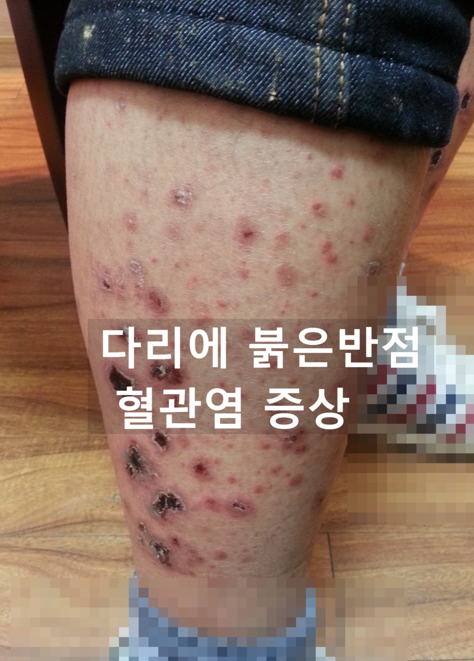 열이반점 이미지