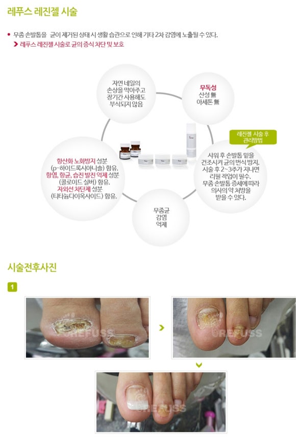 레푸스&양귀비네일 이미지
