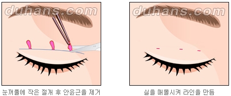 ​[두한성형외과 쌍꺼풀] - [쌍꺼풀수술] 관련 이미지 3