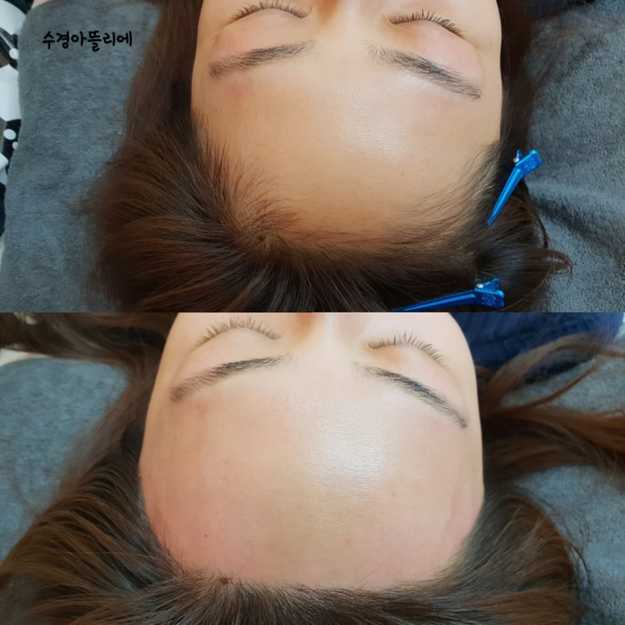 수경헤어라인 이미지