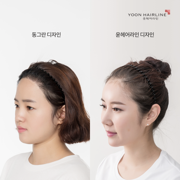정 헤어라인 이미지