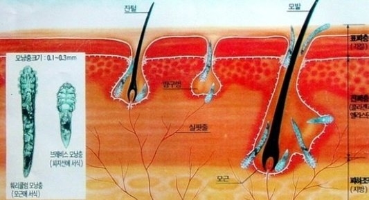 대구가발스칼프채움 이미지