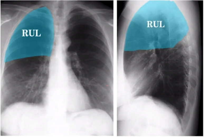 정상 흉부 X선 사진 (X-ray) 해부학 구조, 기본 판독 방법 : 네이버 블로그