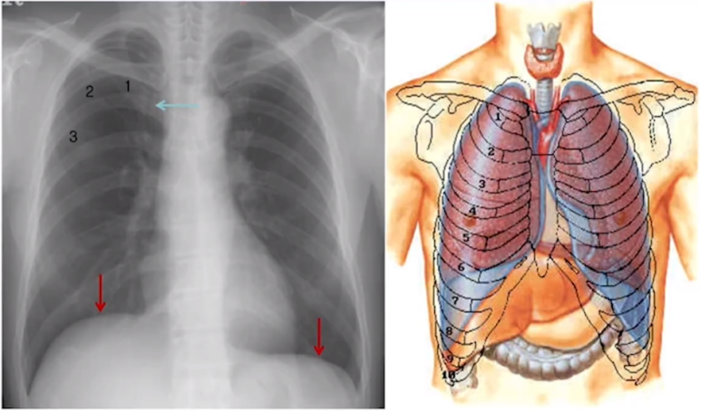 정상 흉부 X선 사진 (X-ray) 해부학 구조, 기본 판독 방법 : 네이버 블로그