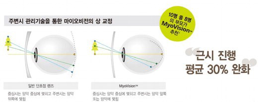 엠씨렌즈 이미지