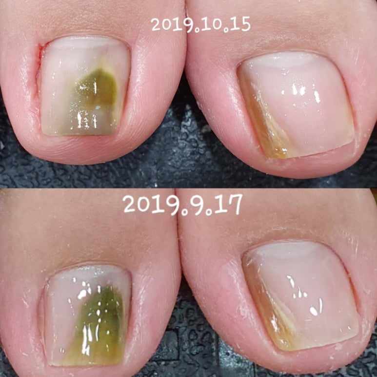 야시손톱 이미지
