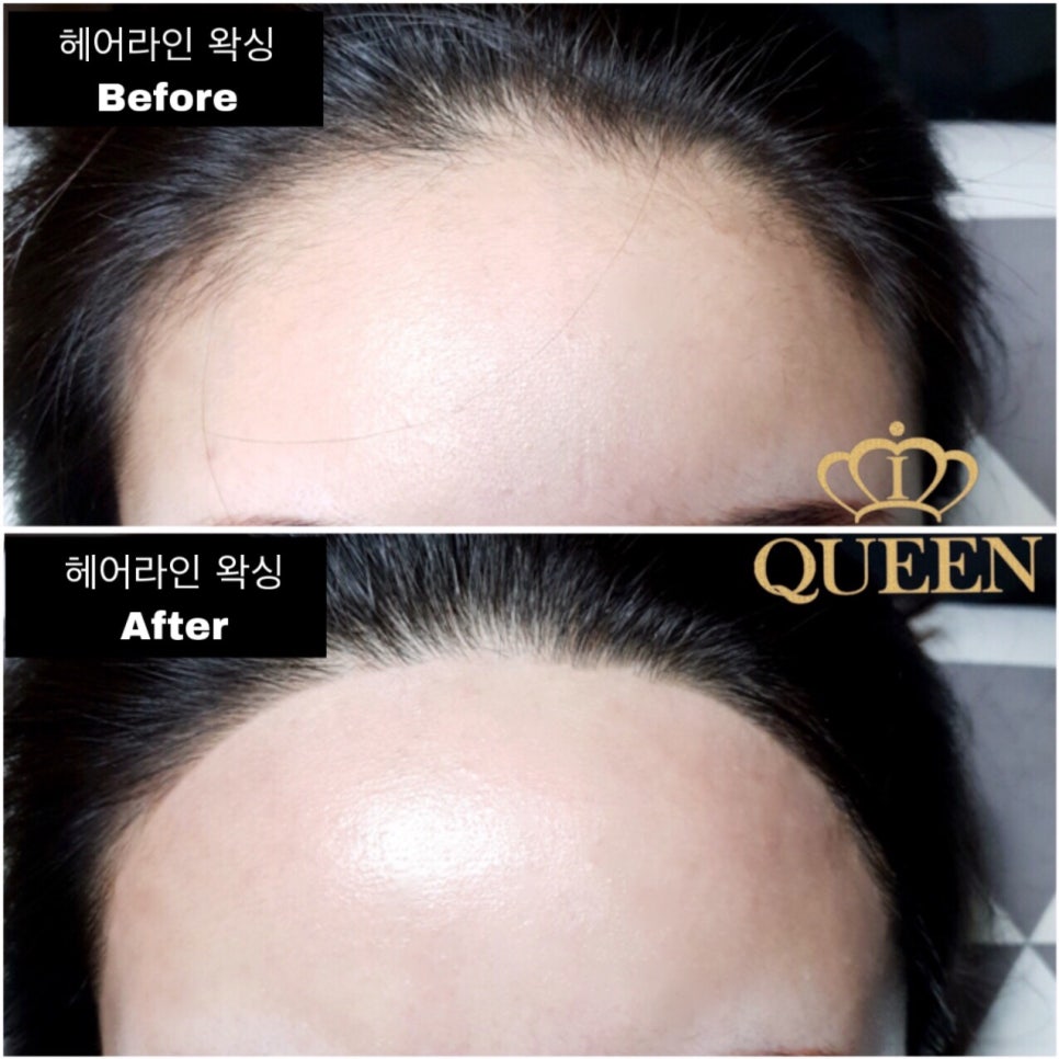 퀸헤어라인 이미지