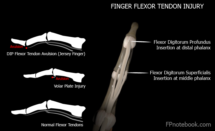 [통증/손] 손가락 다치고 나서 굽혀지지가 않아요. - 손가락 굴곡건 손상(Flexor tendon injury) : 네이버 블로그