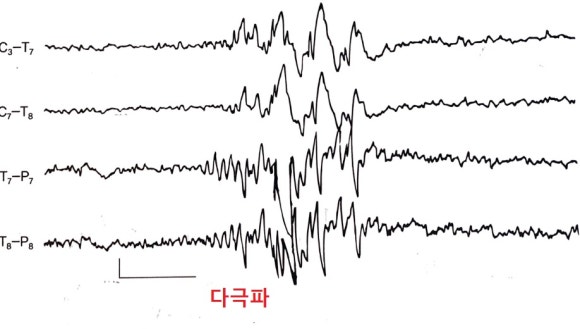알기쉬운 뇌파의 기본 알아보기 : 네이버 블로그