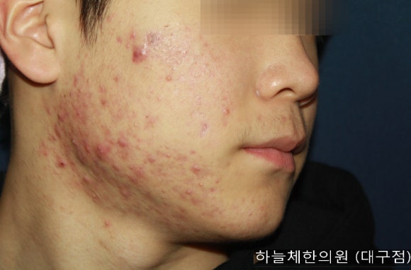 조숙헤어라인 이미지