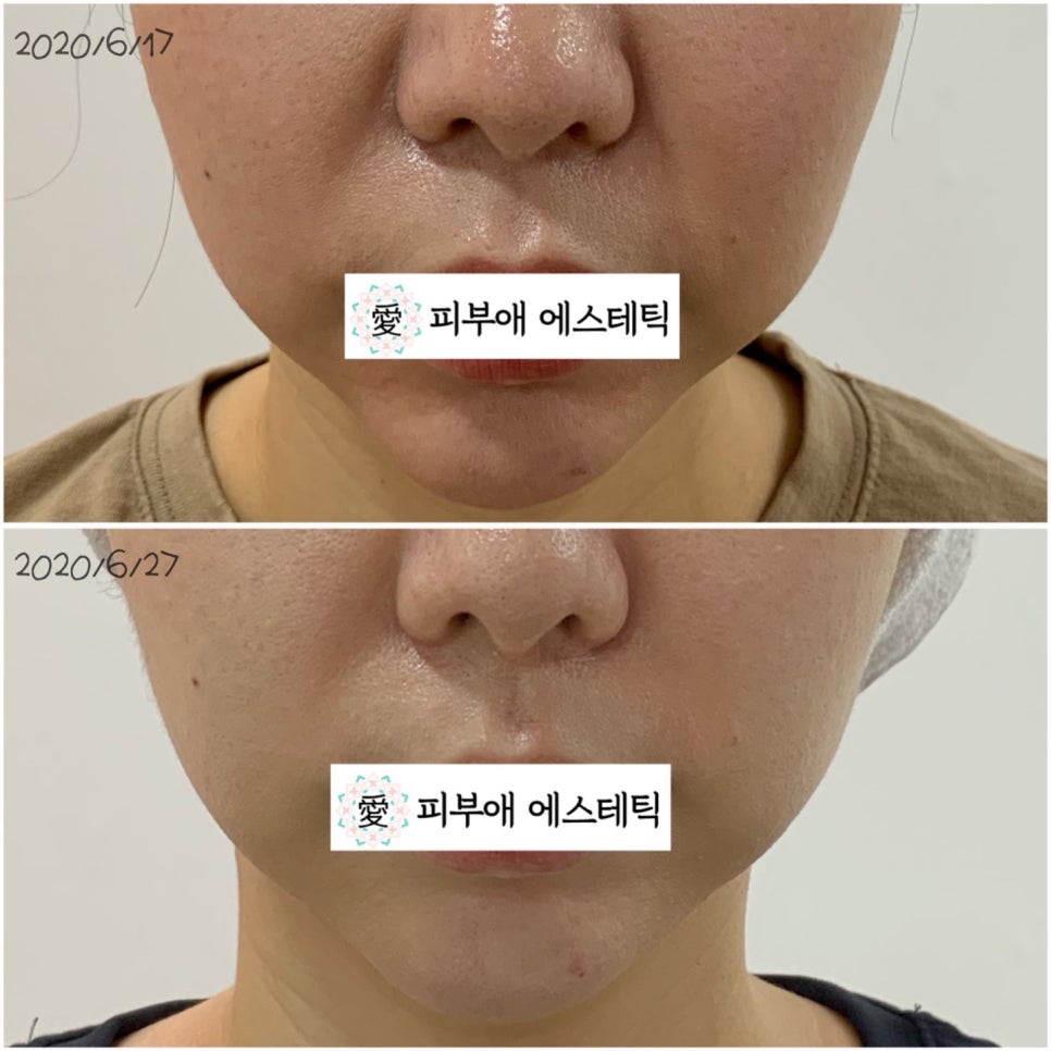 피부애 이미지
