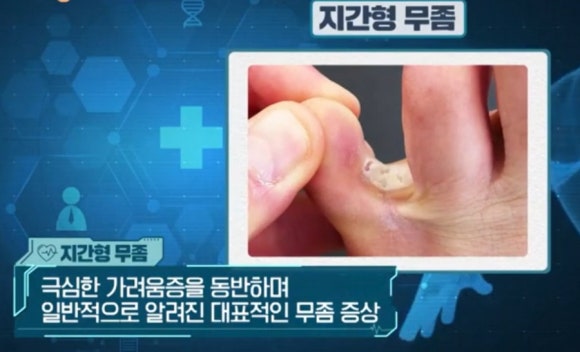 무좀종류-지간형,각화형,수포형,손발톱무좀/사타구니,얼굴,두피 무좀 : 네이버 블로그