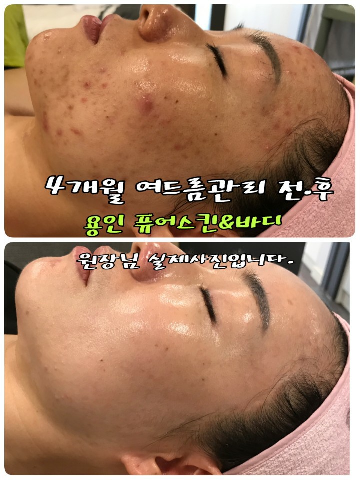 퓨어스킨 이미지