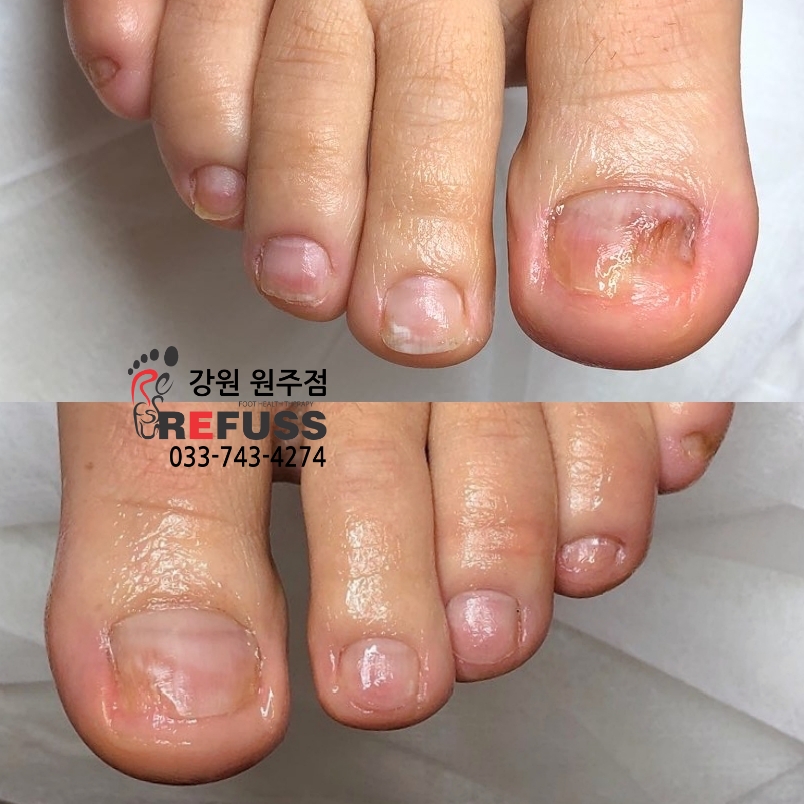 레푸스 이미지