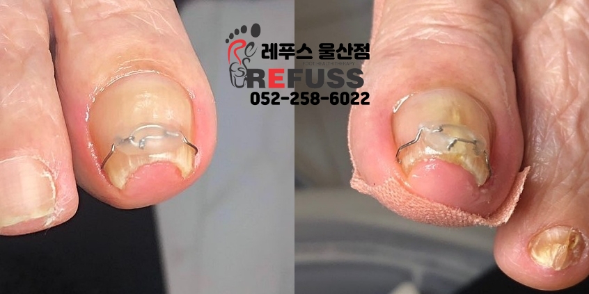레푸스 이미지