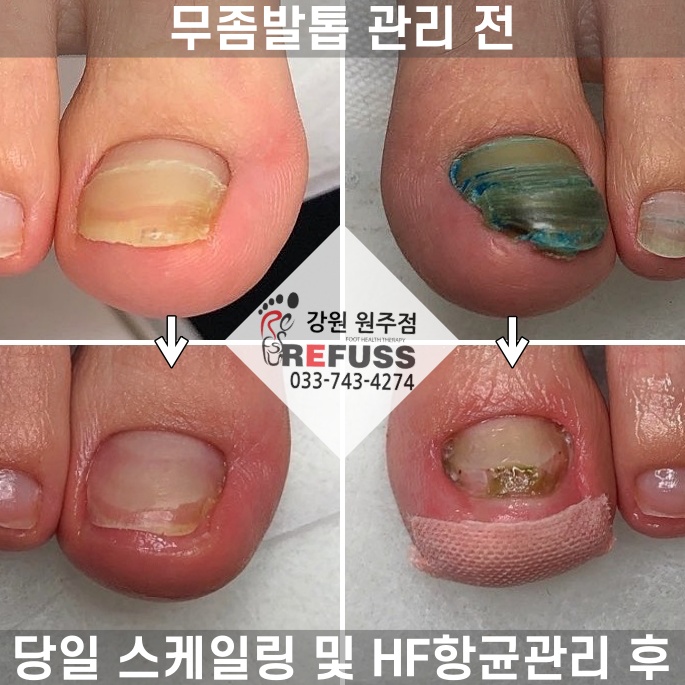 레푸스 이미지