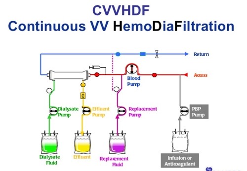 [Rn] ICU의 꽃 CRRT(Continuous renal replacement therapies) 정리 및 간호 : 네이버 블로그