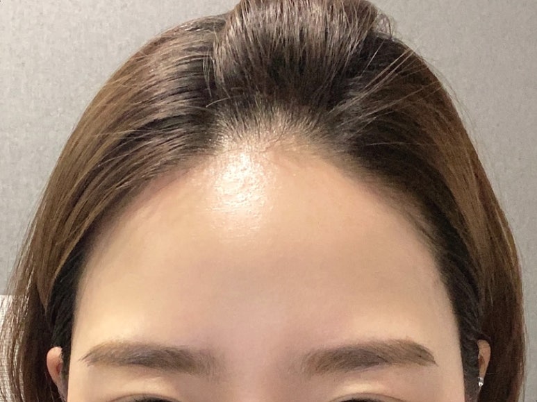 미미헤어라인 이미지