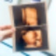 #3. 단일양막 일란성+이란성 세쌍둥이 / 21W 정밀초음파 / 성별확정 : 네이버 블로그