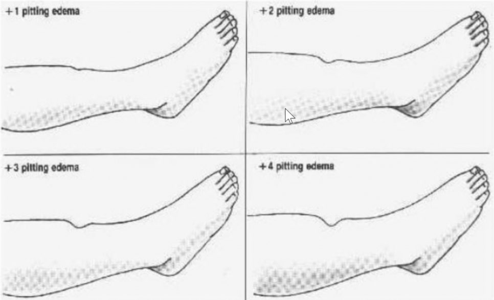 Pitting edema 