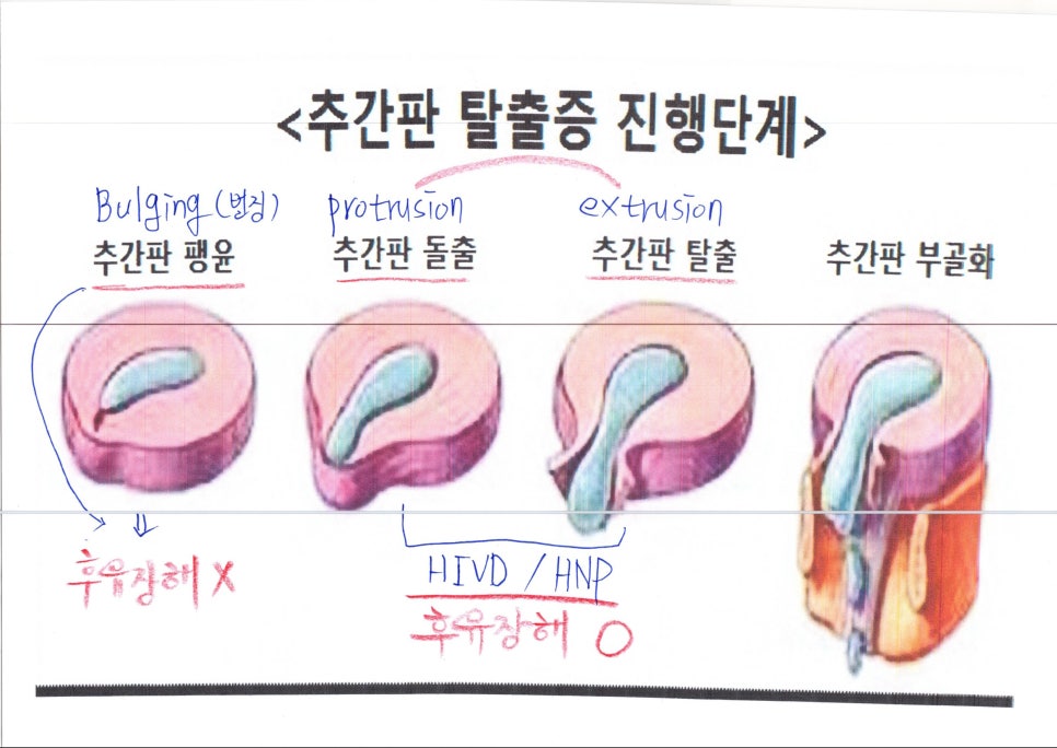 교통사고 추간판탈출증(디스크) 후유장해 : 네이버 블로그