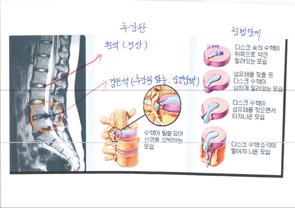 교통사고 추간판탈출증(디스크) 후유장해 : 네이버 블로그