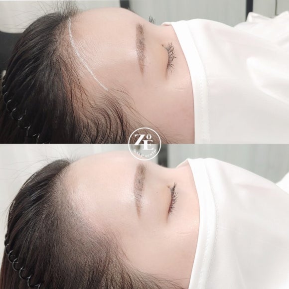 조헤어라인 이미지