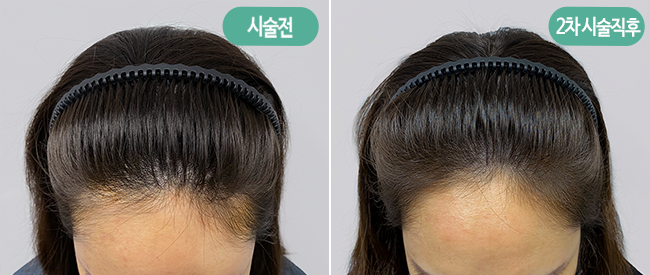 두피앤헤어 이미지