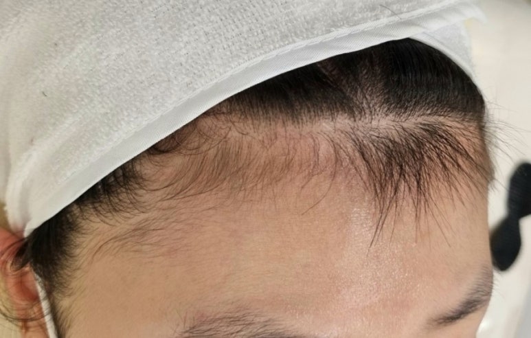 모모헤어라인 이미지