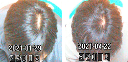 이안두피탈모 이미지