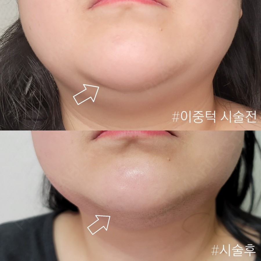 플라즈마 에스테틱 이미지