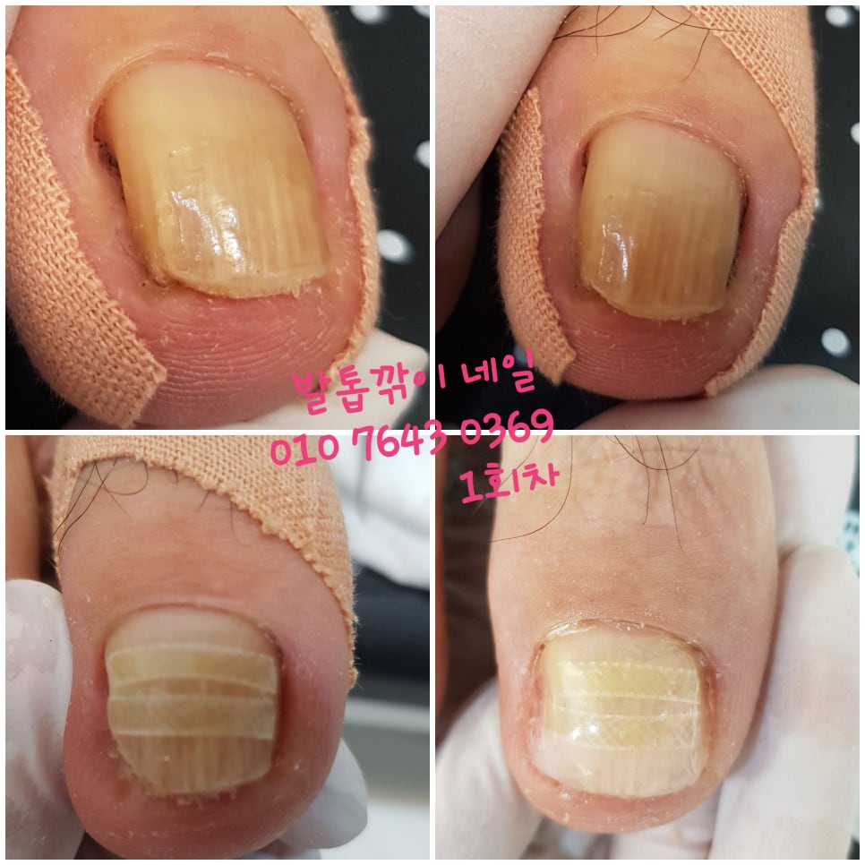 닥터아이티엔발톱깎이 이미지
