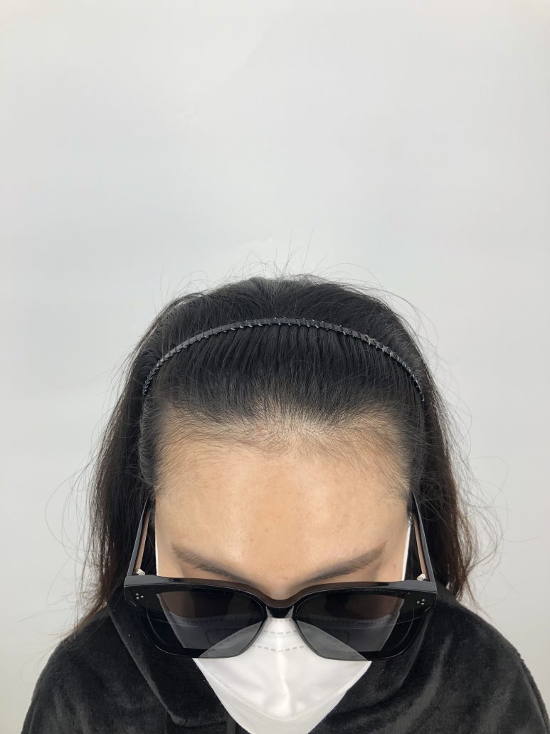 체인지헤어라인 이미지