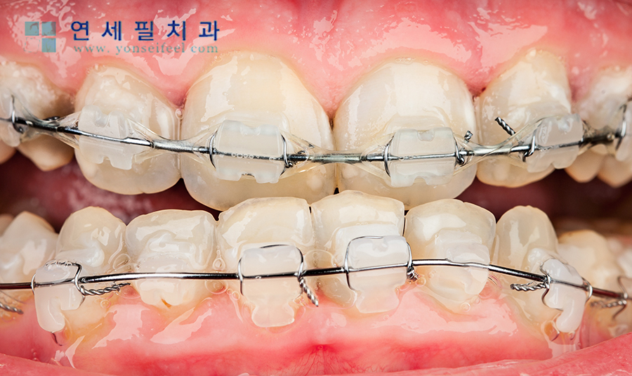 연세필치과교정과 이미지