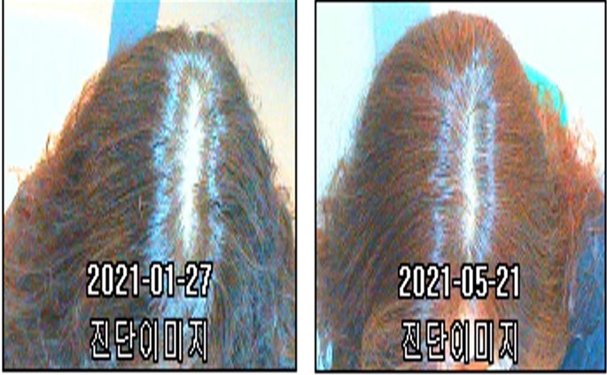 이안두피탈모 이미지
