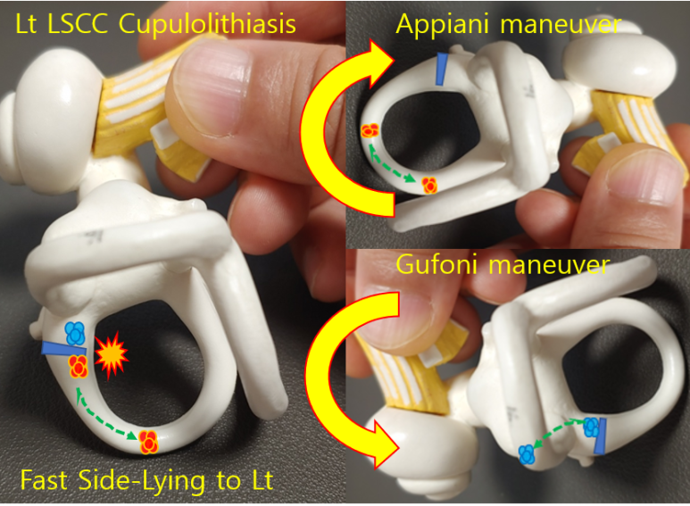 [BPPV][Topic] Gufoni(Appiani) Maneuver의 합리적인 실시 방법에 대한 고민 1. 이론 편 : 네이버 블로그