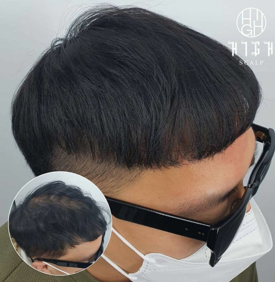 하이스칼프 이미지