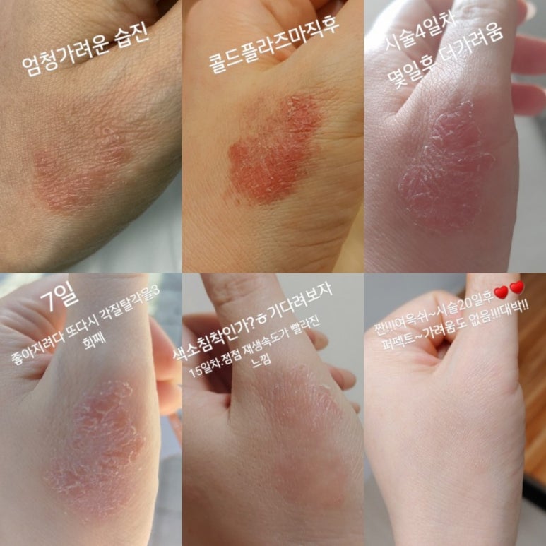 콜드플라즈마 이미지