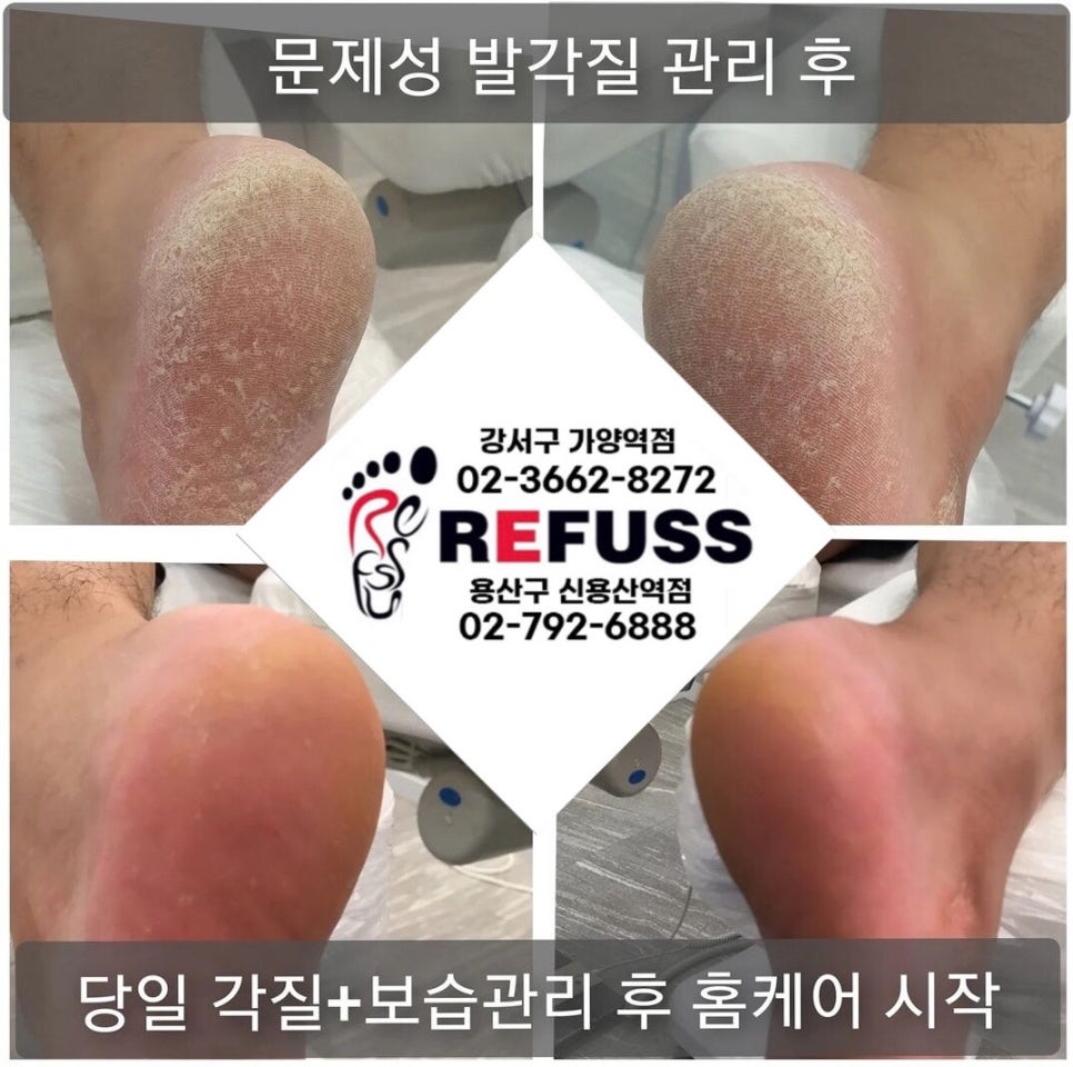 레푸스 이미지