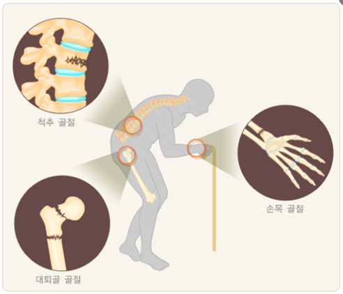 섹칼슘 이미지